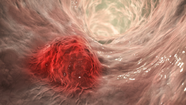 4 "علامات إنذار" لسرطان الأمعاء يمكن أن تظهر قبل التشخيص بسنوات!